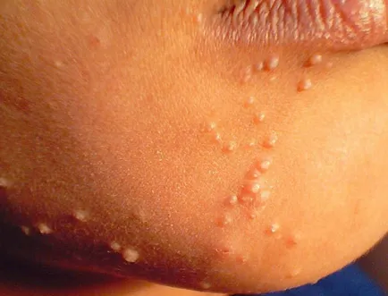 Fotografie: molluscum contagiosum, simptome, tratament la domiciliu, îndepărtarea cu laser