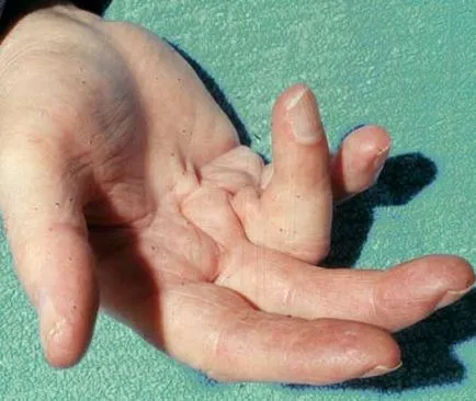 Dupuytren simptome contractura, diagnostic, tratament