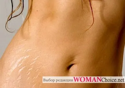 Crema pentru vergeturi - recenzii, mijloacele de întindere (stretching) Crema pentru vergeturi - recenzii, mijloacele de vergeturi