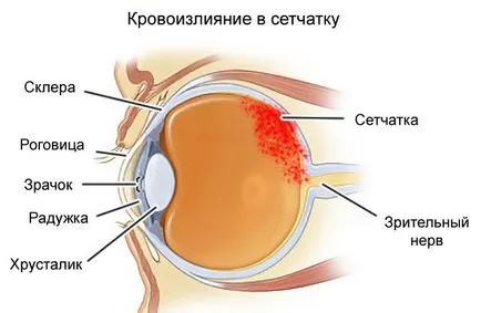 Sangerarea in ochi cauze si tratamente care fac, prognosticul (hemoragie) Sangerarea in cauzele ochi si tratamente care fac, prognosticul