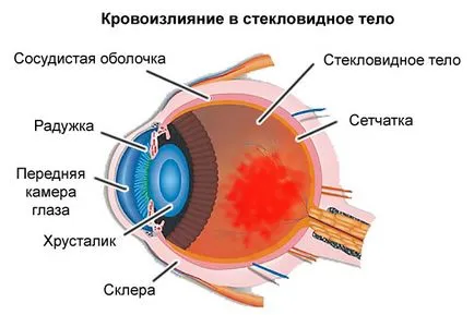 Sangerarea in ochi cauze si tratamente care fac, prognosticul (hemoragie) Sangerarea in cauzele ochi si tratamente care fac, prognosticul