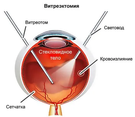 Hemoragia in cauzele si tratamentul ochilor care fac, prognosticul (cauza) Sangerarea in cauzele ochi si tratamente care fac, prognosticul