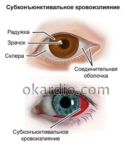 Sangerarea in ochi cauze si tratamente care fac, prognosticul (hemoragie) Sangerarea in cauzele ochi si tratamente care fac, prognosticul