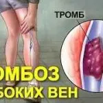 Tratarea venelor varicoase de remedii populare - cum să scape de varice la domiciliu