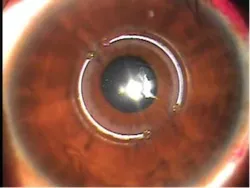 keratoconus