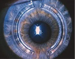 keratoconus