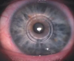 keratoconus