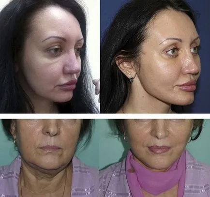 Metode de corectare a conturului facial și bărbia dublă
