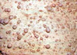 cauze neurofibromatoza, simptome, tratament