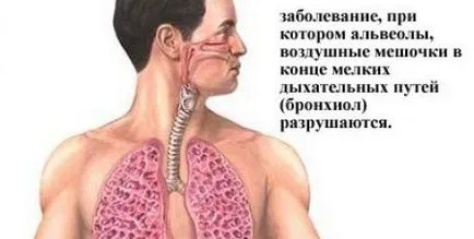 Optic nevrute simptome, tratament si tipuri de nevrita oculare
