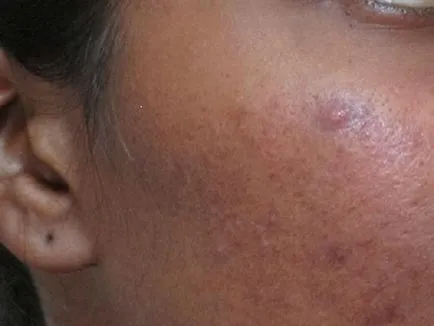 Ce face cosuri pe fata cardului acnee