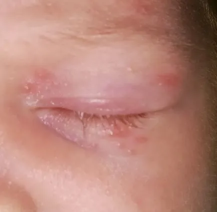 Ce face cosuri pe fata cardului acnee