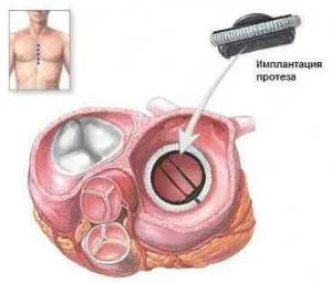chirurgie cardiacă și tipuri de probe (probe) Tipuri de chirurgie cardiacă și indicații