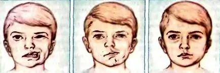 Complicațiile după accident vascular cerebral precoce și tardivă