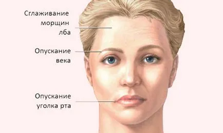Complicațiile de la tipuri de accident vascular cerebral hemoragic de atacuri și analiza lor detaliată