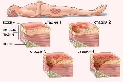 Complicațiile de la tipuri de accident vascular cerebral hemoragic de atacuri și analiza lor detaliată