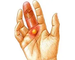 degetele de la mâini și picioare Felon - cât de repede se vindeca inflamatie si prevenirea complicatiilor (diagnostic) degetele de la mâini și picioare Felon - cât de repede se vindeca inflamatie si prevenirea complicatiilor