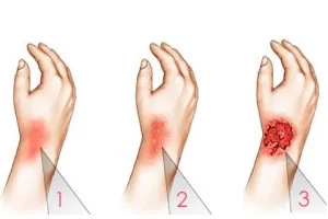 abur arde - primul ajutor la domiciliu, ce să facă (arde mai întâi cu abur de ajutor la domiciliu ce să facă cum să trateze decât tratate ca calma durerea) abur arde - primul ajutor la domiciliu, ce să facă