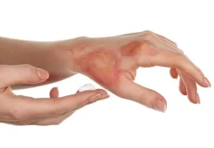 abur arde - primul ajutor la domiciliu, ce să facă (arde mai întâi cu abur de ajutor la domiciliu ce să facă cum să trateze decât tratate ca calma durerea) abur arde - primul ajutor la domiciliu, ce să facă