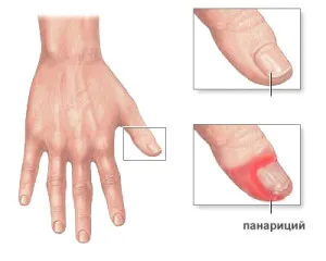 degetele de la mâini și picioare Felon - cât de repede se vindeca inflamatie si prevenirea complicatiilor (degete) degetele de la mâini și picioare Felon - cât de repede se vindeca inflamatie si prevenirea complicatiilor