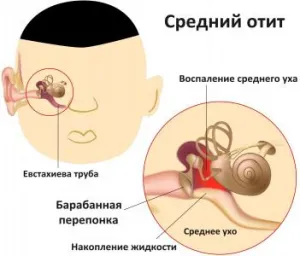 Otita la un copil simptome și tratament (simptome) Otita la un copil simptome și tratament