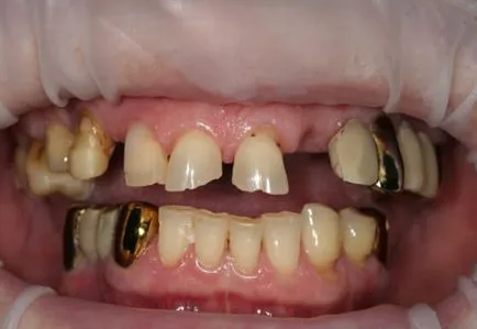 Respingerea implanturi dentare - simptome, semne, cauze