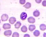 Piroplasmozei - cauze, simptome, diagnostic și tratament