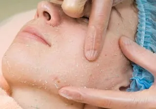 Exfoliantă rola de la paltonul pentru a face față examinării înseamnă populare (peeling) Exfoliantă rola de la paltonul pentru a face față examinării înseamnă populare