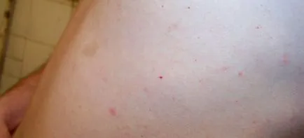 Puncte hepatice asupra cauzelor organismului, tratamentul, prevenirea