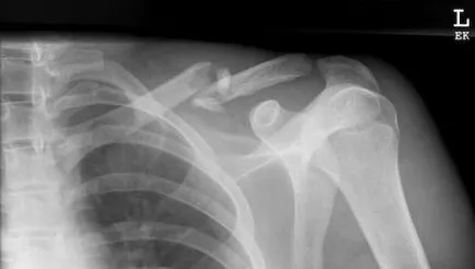 Fractura de clavicula cu tratament de deplasare, operarea și perioada de recuperare (fractură) Fractura de clavicula cu un tratament de deplasare, operarea și perioada de recuperare
