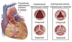 valve semilunare