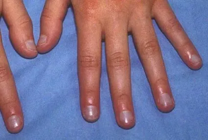 Transformat unghiile albastre principalele cauze ale bolilor