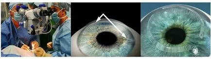 Cauzele și tratamentul ochilor keratoconus