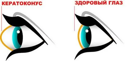 Cauzele și tratamentul ochilor keratoconus
