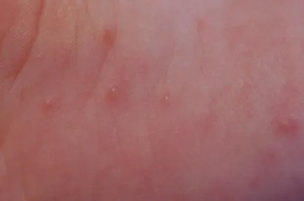 Bulele opririle foto, posibil boli, tratament, boli fungice