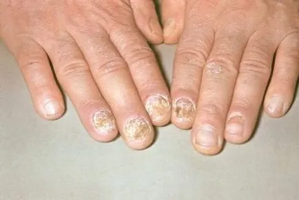 remedii populare unghiilor psoriazis tratament acasa, sfaturi video, (cuie) Unghiilor psoriazis tratament acasa remedii populare, sfaturi video,
