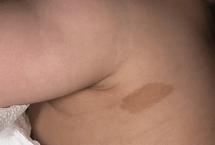 Valoarea birthmarks de localizare și aspectul lor (spoturi) Valoarea birthmarks a locației și aspectul lor