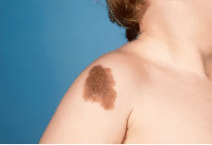 Nevilor valoarea lor (corpul birthmark pe partea din spate a fesei mână valoarea lui coapsa gât picior) Locul de amplasare și aspectul Valoarea birthmarks a locației și aspectul lor