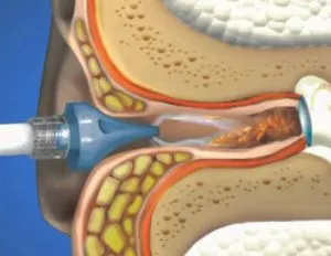 Impaction cerumen în ureche cauze, simptome, metode de îndepărtare, de spălare și de prevenire, fotografii