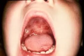 Erupții cutanate de infecție cu enterovirus la copii - o descriere și foto (copii) Erupții cutanate de infecție cu enterovirus la copii - o descriere și fotografie