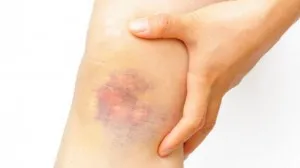 Vânătaie după ce a luat sânge dintr-o venă și echimoze de preparate injectabile decât vindecarea (după) Vânătaie după ce a luat sânge dintr-o venă și vânătăi de la preparate injectabile decât vindecarea