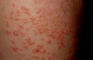 Erupții cutanate de infecție cu enterovirus la copii - o descriere și fotografie (enterovirus) Erupții cutanate de infecție cu enterovirus la copii - o descriere și fotografie