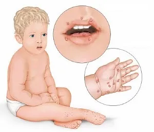 Erupții cutanate de infecție cu enterovirus la copii - o descriere si fotografii (de sănătate a copilului) Erupții cutanate de infecție cu enterovirus la copii - o descriere și fotografie