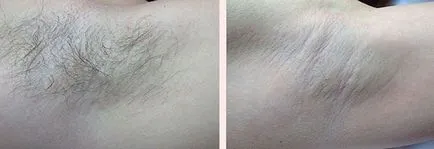 Shugaring sau păr de zahăr de îndepărtare - cel mai sigur mod de a scăpa de păr (păr) Shugaring sau păr de zahăr de îndepărtare - cel mai sigur mod de a scăpa de păr