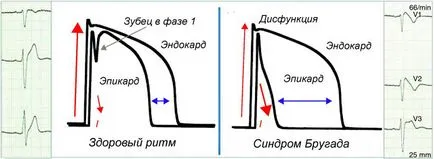 Sindromul de repolarizării ventriculare precoce ce este manifestarea pe ECG