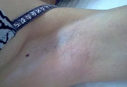 Shugaring sau păr de zahăr de îndepărtare - cel mai sigur mod de a scăpa de păr (păr) Shugaring sau păr de zahăr de îndepărtare - cel mai sigur mod de a scăpa de păr