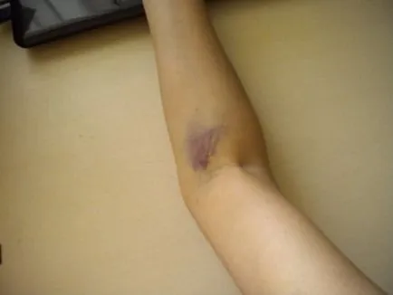 Vânătăile de preparate injectabile - periculoase și cum să trateze