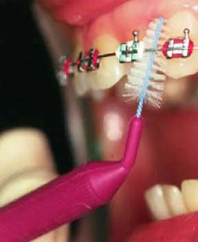 Sfaturi ortodontist