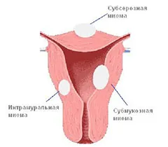 fibrom subseros - Simptome, Diagnostic si Tratament