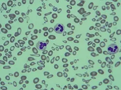 Talasemia - tratament, diagnostic, simptome, cauze